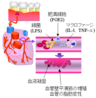 歯周病 抗生物質 期間