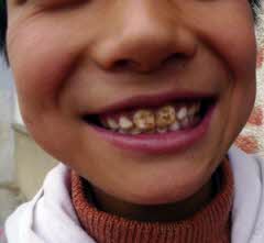 sDentalFluorosis-300x276.jpg(5522 byte)