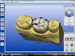 cerec3d