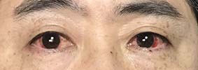 眼帯写真