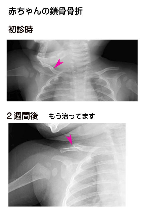 剥離 骨折 早く 治す 方法