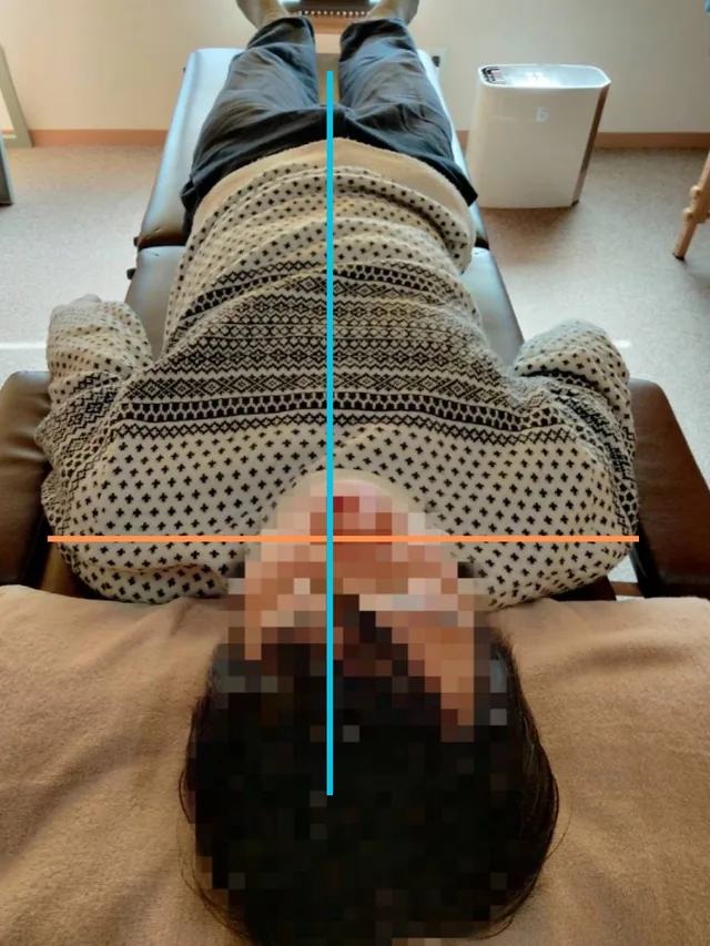 施術後の姿勢確認写真。中心線と肩まわりの目安線を入れています。