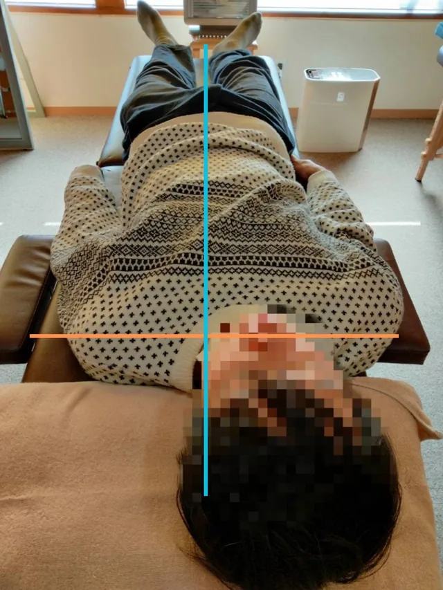 施術前の姿勢確認写真。中心線と肩まわりの目安線を入れています。