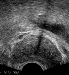 前立腺超音波画像