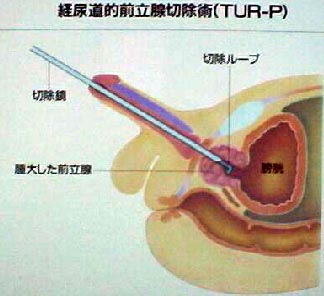 内腺を切除する手術