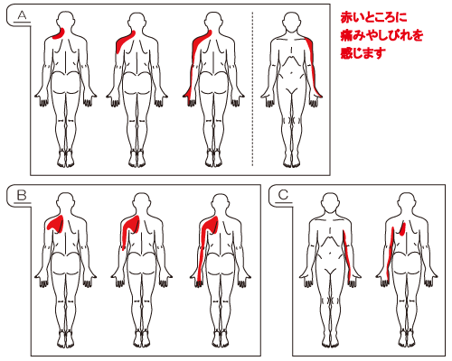 腰椎の疾患 頚椎の疾患 関連リンク トップページ 病気の解説 手術の説明 くすりの説明 その他 頚椎椎間板ヘルニア どのような病気ですか ヘルニアとは臓器などが脱出した状態を指す医学用語です 椎間板ヘルニアの場合は椎間板という脊椎の